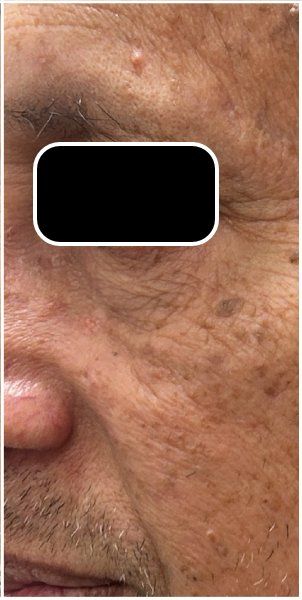 Q-Switch Nd:YAG Laser after — Sun Spots, Seborrheic Keratosis, Brown Spots, Sun Damage, front view