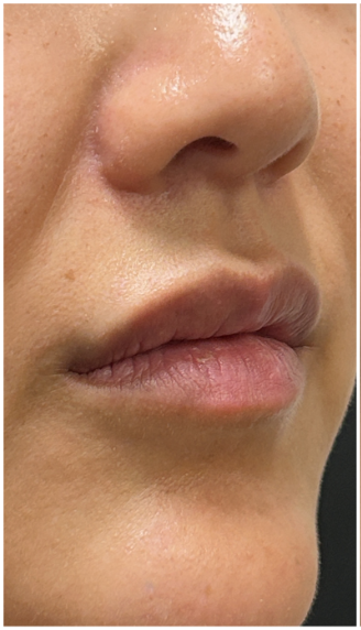 Lip Filler Dissolve before — Filler Migration, front view