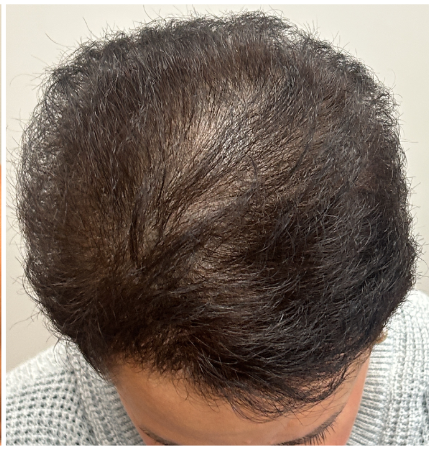Exosome Hair Therapy after — Female Pattern Hair Loss, Crown Thinning, Central Scalp Density Loss, front view