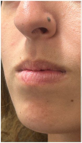 Lip Filler before — Lip Volume, Lip Projection, Lip Profile, front view