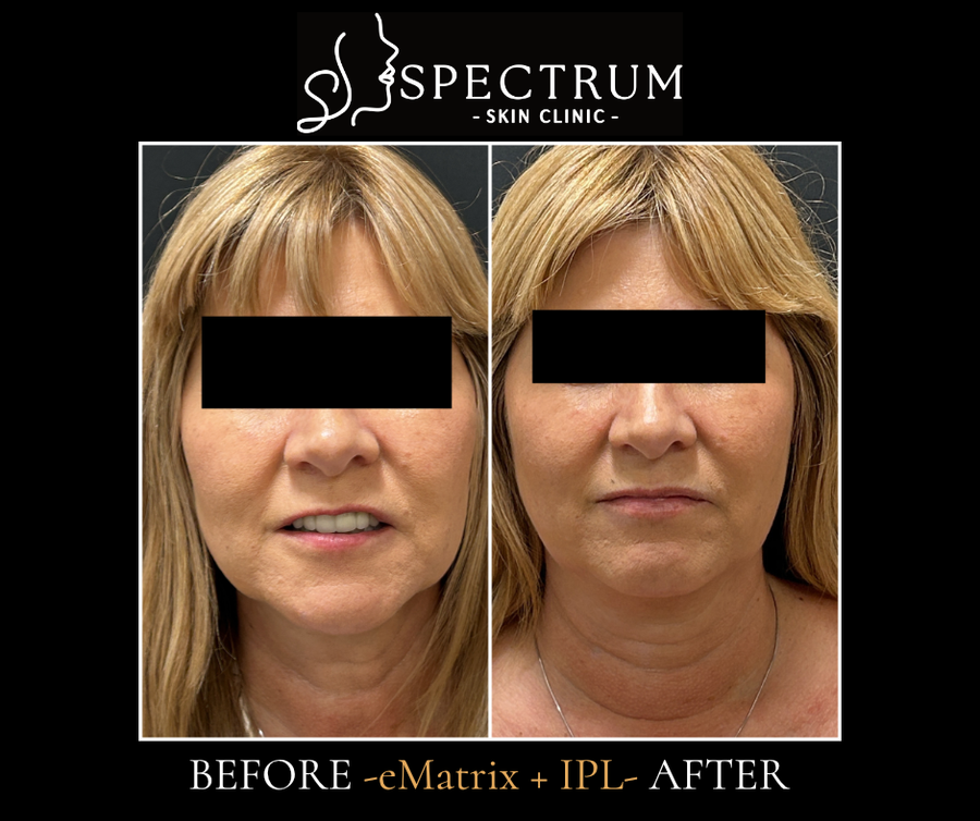eMatrix + IPL Before and After, Photodamage Correction and Skin Tightening at Spectrum Skin Clinic, Irvine
