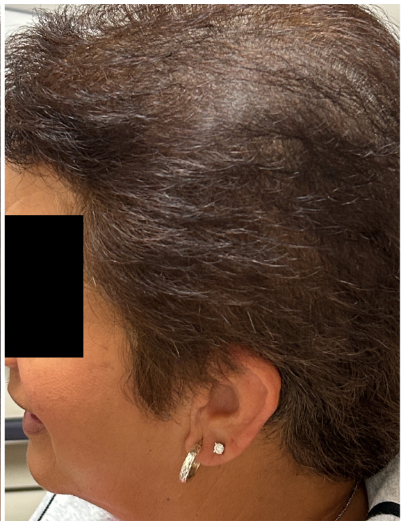Exosome Hair Therapy after — Hair Thinning, Reduced Hair Density, Visible Scalp Coverage, front view