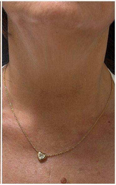 Q-Switch Nd:YAG Laser after — Sun Damage, Brown Discoloration, Uneven Skin Tone, Neck and Chest, front view