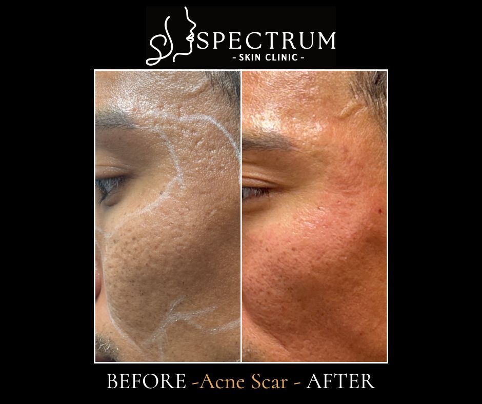 Acne Scar Before & After | CO2, RF Microneedling, Subcision and Rejuran on the Cheek