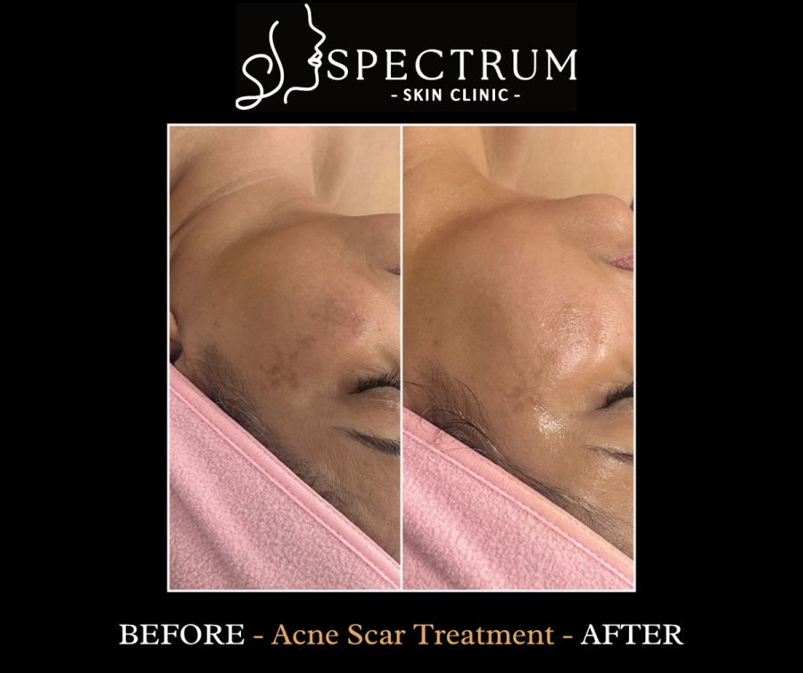 Chemical Peel Before and After | Acne Scar Texture Improvement