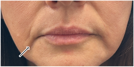 Filler Dissolve after — Marionette Lines, Lower Face Sagging, Filler Migration, front view