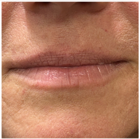 Lip Filler before — Perioral Aging, Lip Lines, front view