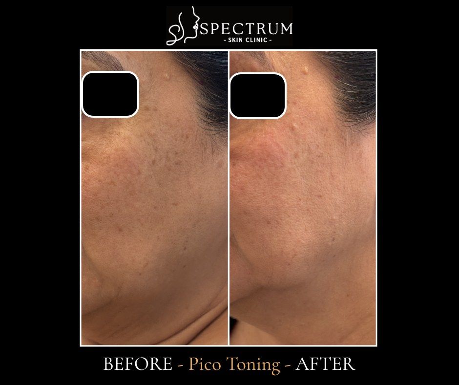 Pico Toning Before & After | Brown Spots and Uneven Tone