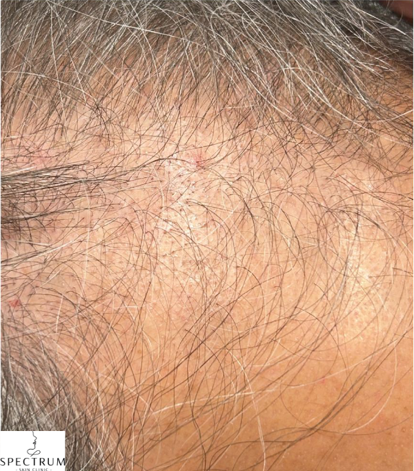 Exosome Therapy before — Post-Menopausal Hair Thinning, Crown Density Loss, front view