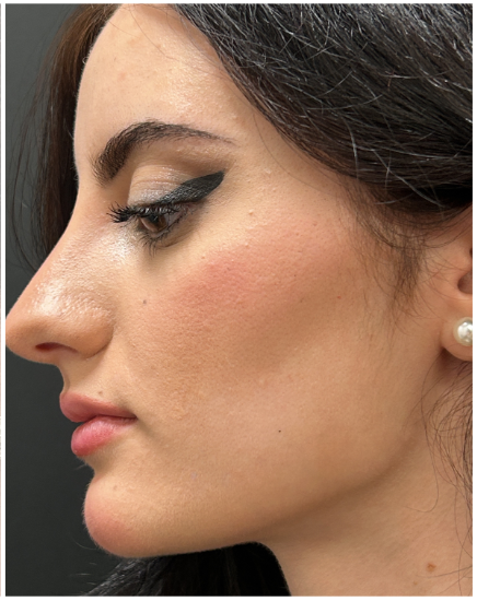 Masseter Botox after — Wide Jawline, Bruxism / TMJ, front view