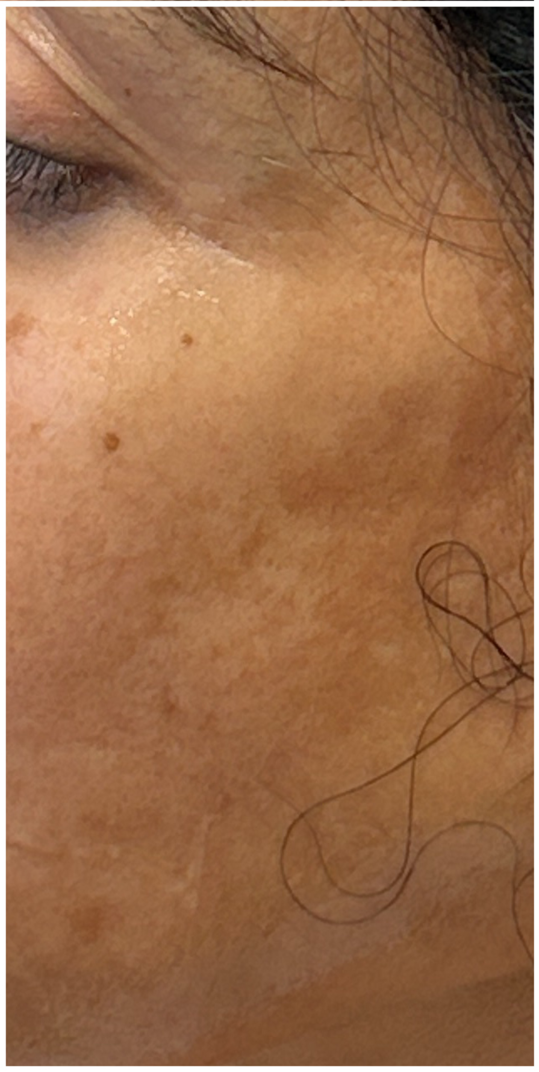 IPL Photofacial, Nordlys IPL before — Sun Damage, Hyperpigmentation, Facial Redness, Visible Vessels, Uneven Skin Tone, front view