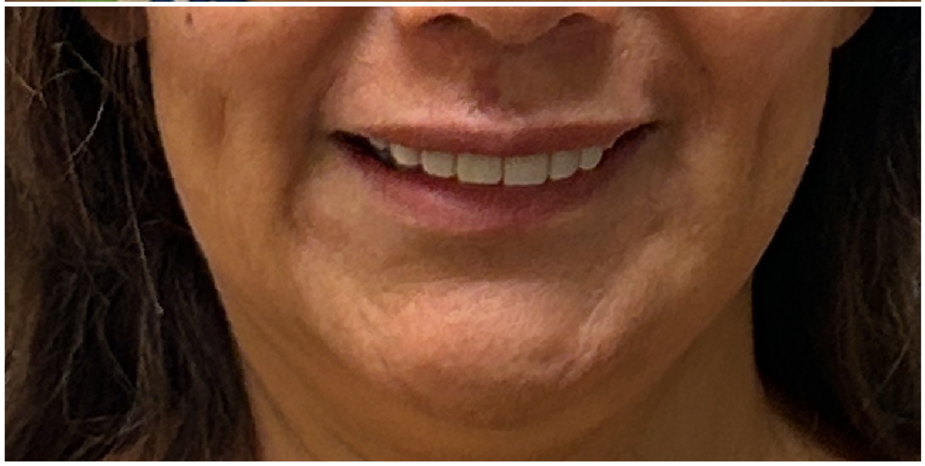 Chin Filler after — Marionette Lines, Weak Chin, Lower Face Definition, Sagging and Laxity, front view
