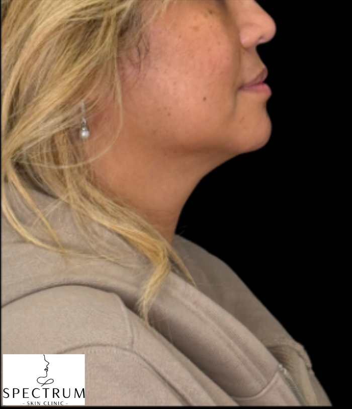 HIFU before — Sagging and Laxity, Double Chin, Lower Face Sagging, Jowling, front view