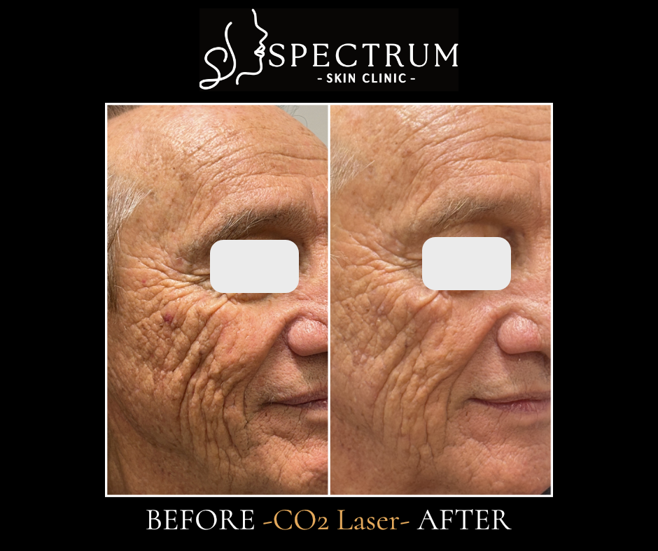 CO2 Laser Before & After | Crow’s Feet and Cheek Wrinkle Resurfacing