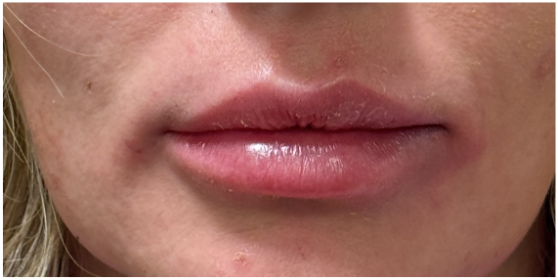Lip Filler after — Thin Lips, front view