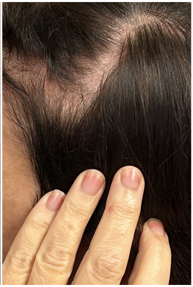 PRFM Hair Therapy after — Focal Density Loss, Hair Thinning, Reduced Scalp Coverage, front view
