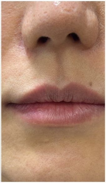 Lip Filler after — Lip Volume, Lip Definition, Lip Texture, front view