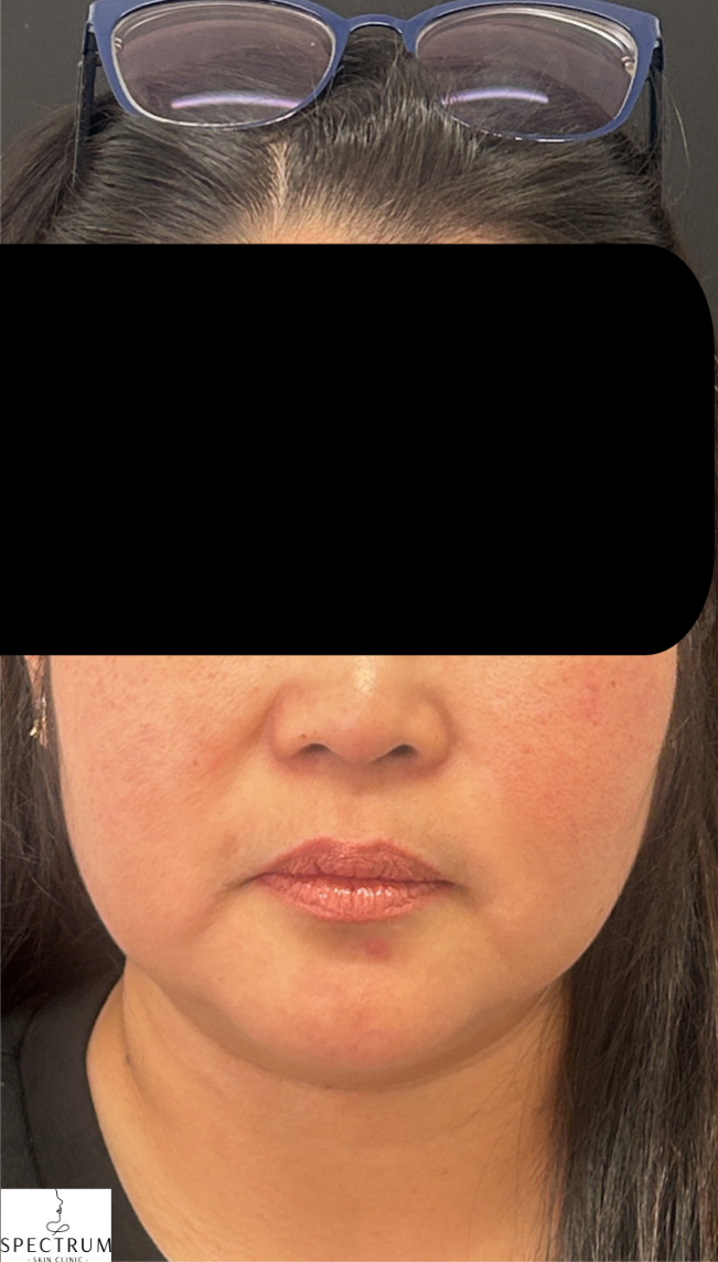 HIFU after — Sagging and Laxity, Double Chin, Skin Tightening, front view