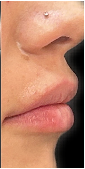Lip Filler after — Thin Lips, front view