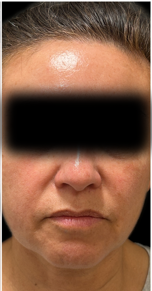 IPL Photofacial, Nordlys IPL after — Rosacea, Facial Redness, Hyperpigmentation, Sun Damage, Visible Vessels, front view