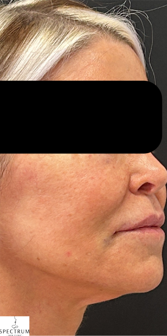 Chin Filler, Marionette Filler after — Marionette Lines, Weak Chin, Lower Face Definition, Lower Face Sagging, front view