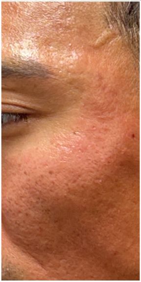 Fractional CO2, RF Microneedling, Subcision, Rejuran after — Atrophic Acne Scarring, Rolling and Boxcar Scars, Skin Texture, front view