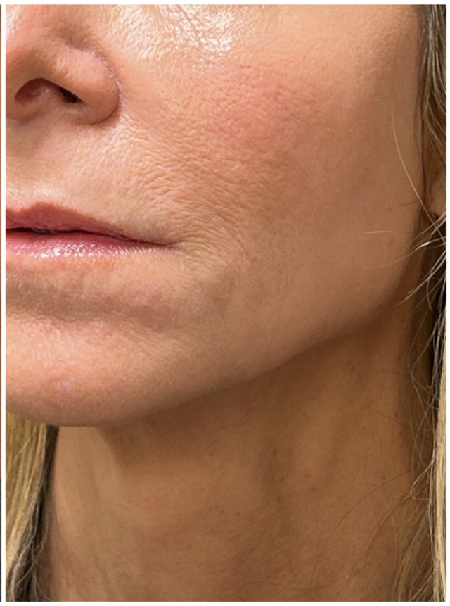 CO2 Laser Resurfacing Before & After | Skin Texture and Tone Renewal — after