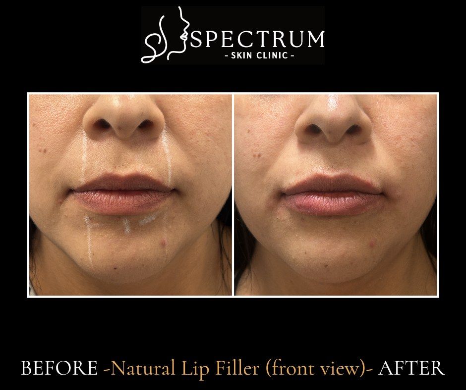 Natural Lip Filler Before & After | Soft Volume (Front View)