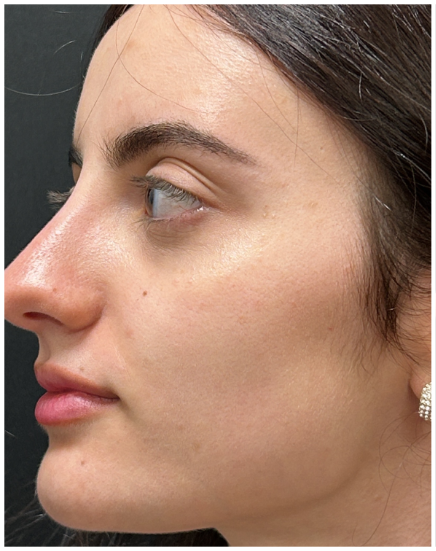 Masseter Botox before — Wide Jawline, Bruxism / TMJ, front view