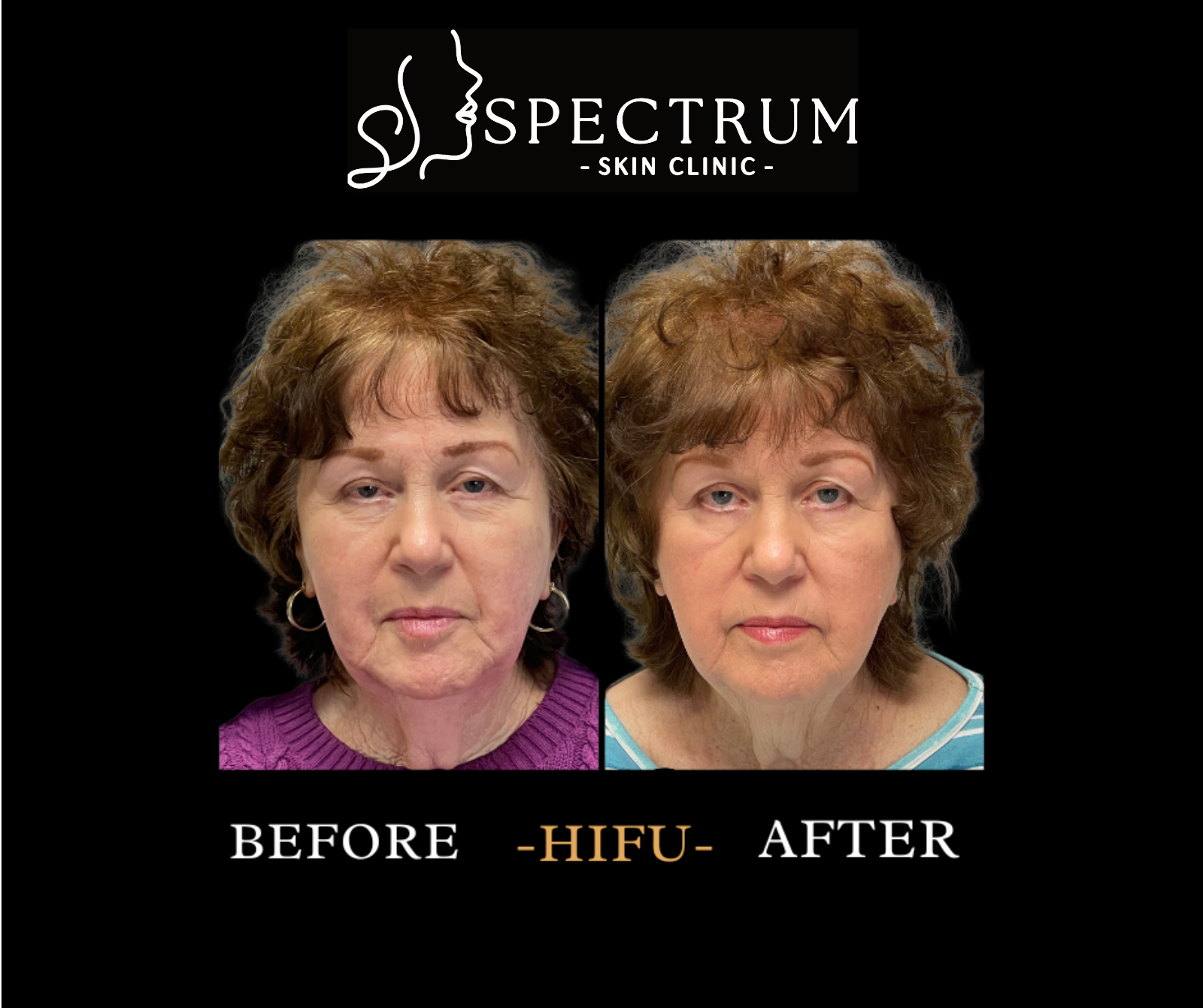 HIFU Full Face Before & After | Comprehensive Non-Surgical Lift