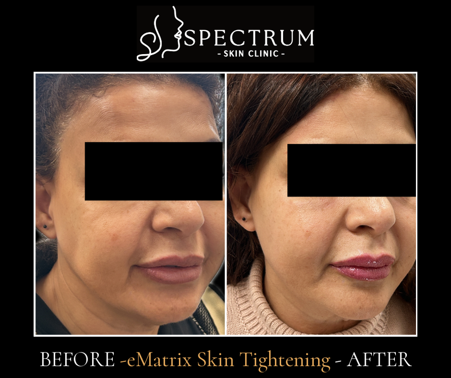 eMatrix Before and After, Non-Ablative RF Skin Tightening at Spectrum Skin Clinic, Irvine