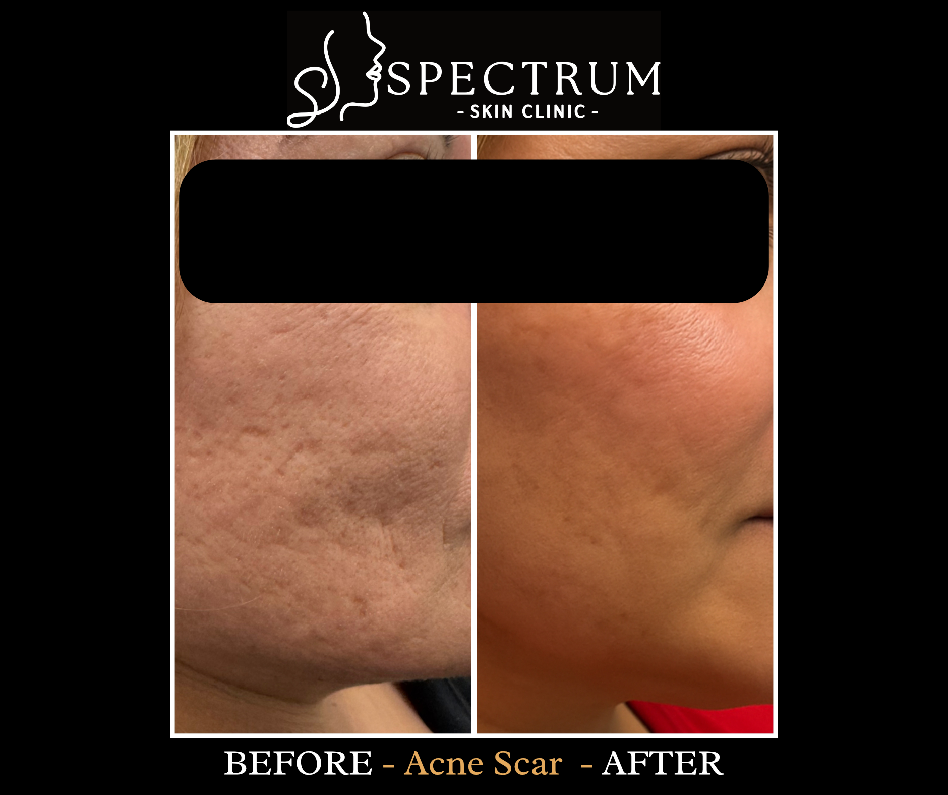 Acne Scar Treatment Before & After | RF Microneedling and TCA Cross Peel