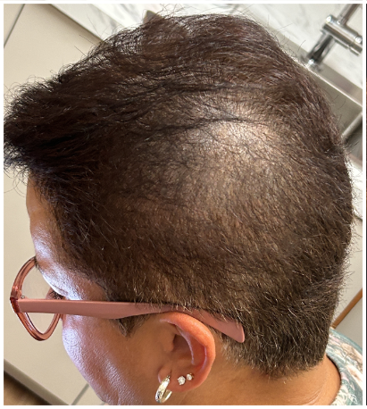 Exosome Hair Therapy before — Asymmetric Hair Thinning, Part-Line Visibility, Left-Side Crown Thinning, front view