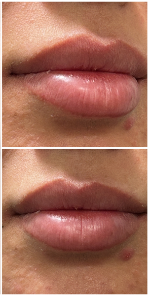 Lip Filler after — Thin Lips, front view