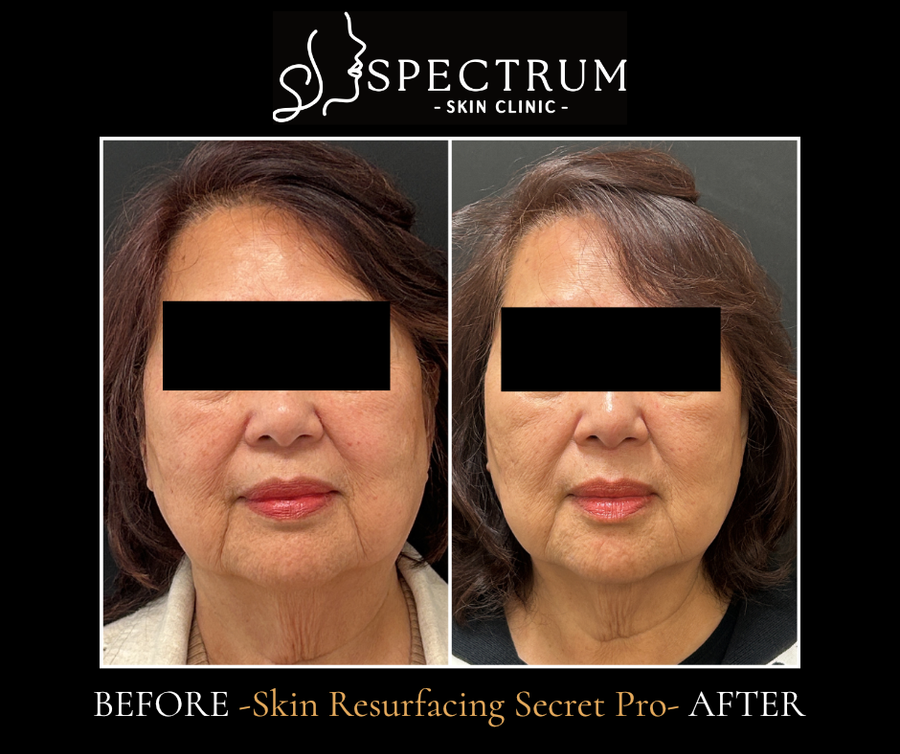 Skin Resurfacing Before & After | Smoother Texture and Firmer Skin