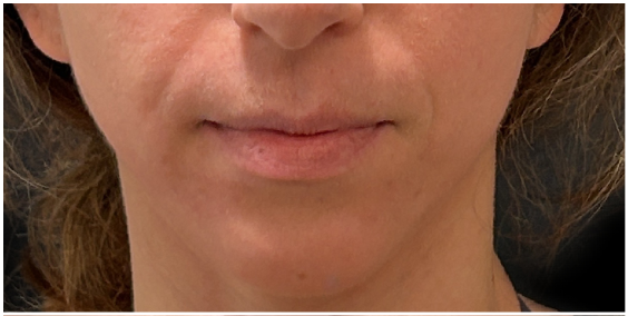 Filler Dissolve before — Nasolabial Folds, Filler Migration, Lower Face Heaviness, front view