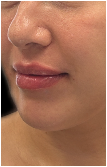 Lip Filler after — Thin Lips, front view