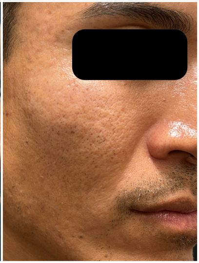 Fractional CO2, RF Microneedling, Subcision, Rejuran after — Atrophic Acne Scarring, Rolling and Boxcar Scars, Skin Texture, front view