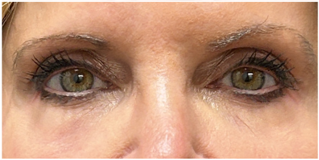 CO2 Laser Resurfacing for Eyes Before & After | Fine Line and Texture Renewal — after