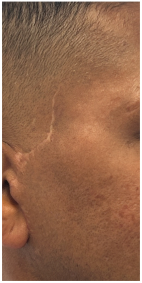 RF Microneedling after — Trauma Scars, Uneven Texture, Hypertrophic Scars, front view