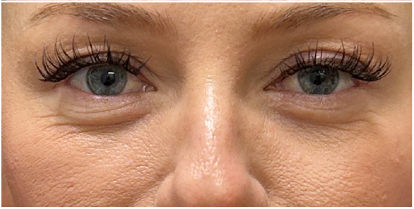 PRFM Under Eye after — Fine Lines and Wrinkles, Crepey Eyelid Skin, Skin Quality, front view
