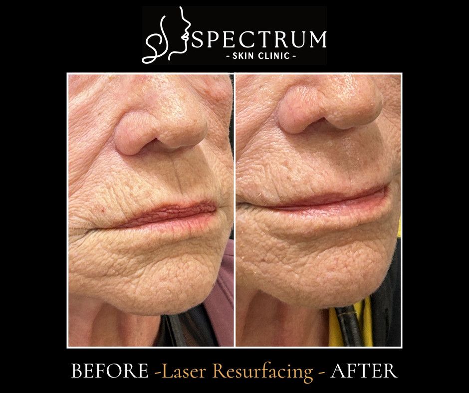 Frax CO2 Before & After | Perioral Line Resurfacing (Side View)