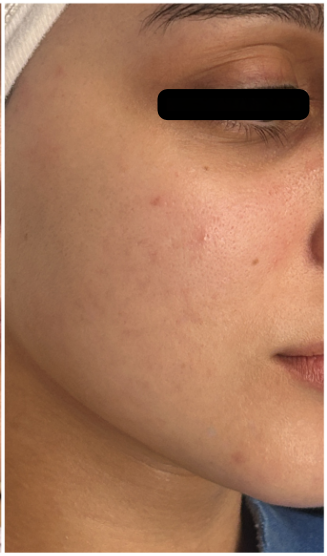 Acne Facial after — Active Acne, Inflammatory Acne, Comedones, Breakouts, front view