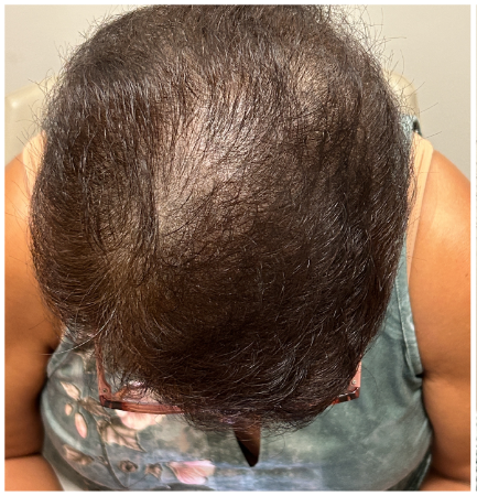 Exosome Hair Therapy before — Female Pattern Hair Loss, Crown Thinning, Central Scalp Density Loss, front view