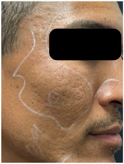 Fractional CO2, RF Microneedling, Subcision, Rejuran before — Atrophic Acne Scarring, Rolling and Boxcar Scars, Skin Texture, front view