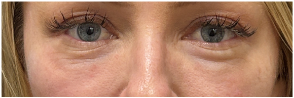 Under Eye Filler Dissolve, PRFM Under Eye before — Under Eye Hollows, Filler Migration, Crepey Eyelid Skin, Skin Quality, front view