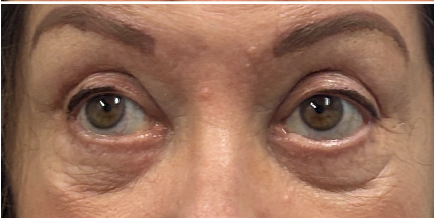 eMatrix Sublative after — Fine Lines and Wrinkles, Crepey Eyelid Skin, Uneven Texture, front view