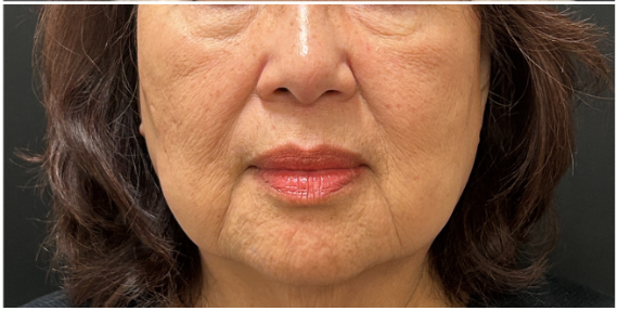 CO2 Laser Resurfacing after — Fine Lines and Wrinkles, Sagging and Laxity, Sun Damage, front view