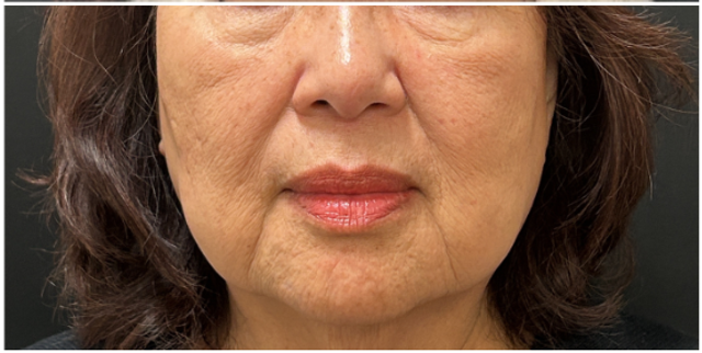 Laser Skin Resurfacing Before & After | CO2 for Fine Lines and Skin Tightening — after