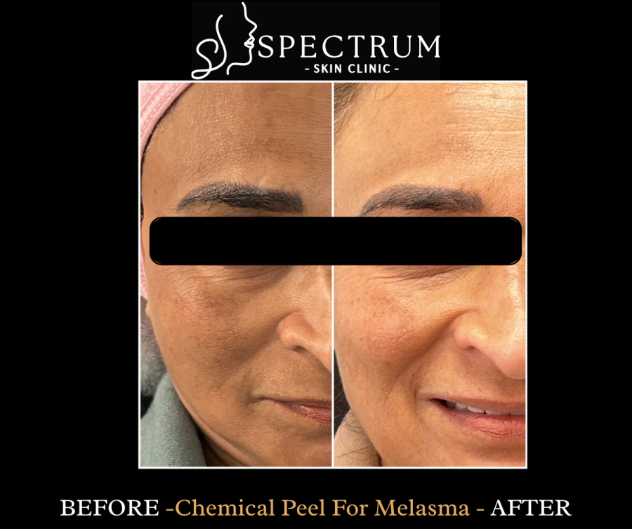 Chemical Peel Before and After | Melasma Lightening
